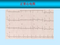 正常心电图是什么样的