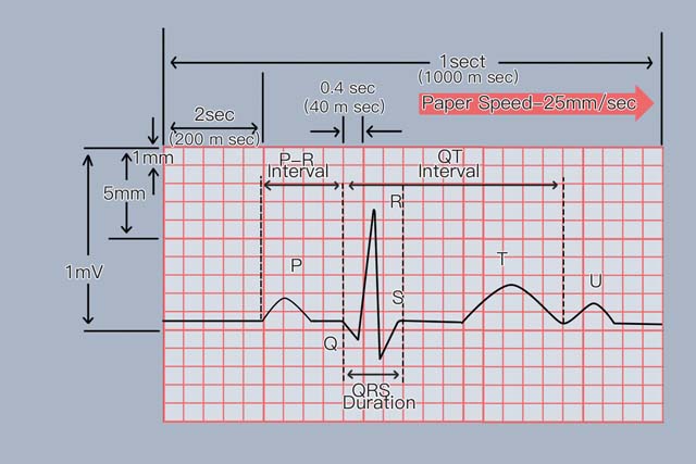 正常心电图波形特点和正常值