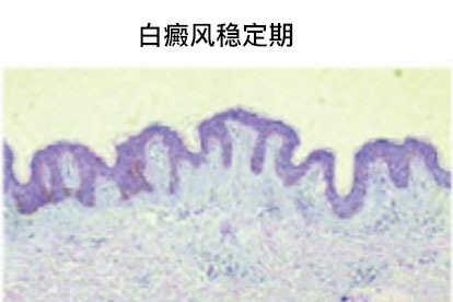 白癜风稳定期图