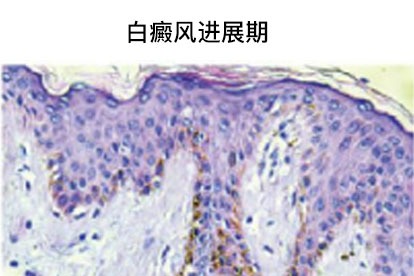 白癜风进展期图