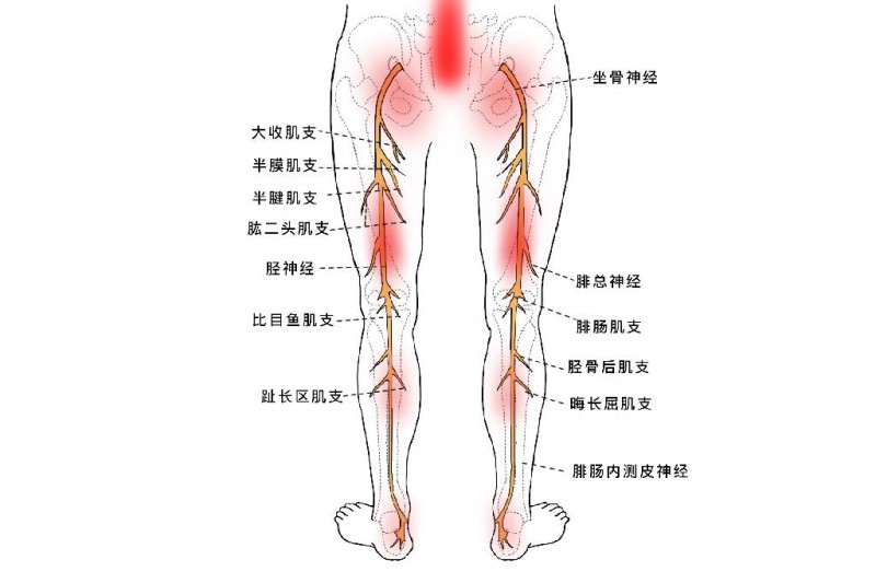 坐骨神经痛的疼点图