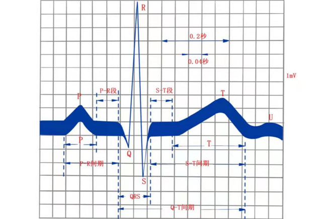 正常心电图