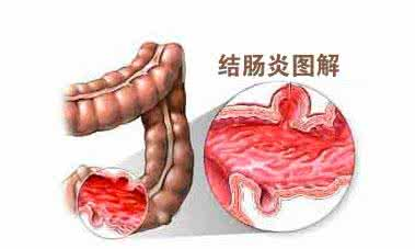 结肠炎症状有哪些呢 结肠炎吃什么药好 怎么治疗