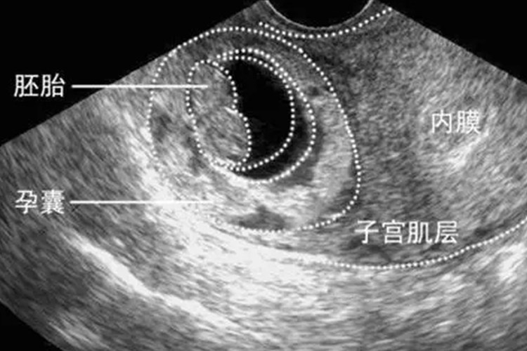 孕囊是圆形是男孩还是女孩 早孕孕囊椭圆形是男孩还是女孩
