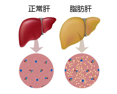 脂肪肝的危害有哪些 脂肪肝的坏处都有哪些