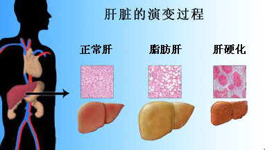 脂肪肝的症状有什么危害吗 脂肪肝严重会对肝造成损害吗