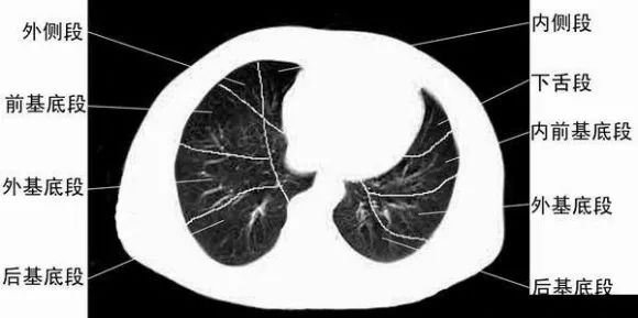 体检尽量别做肺部CT 体检为什么不做肺部CT