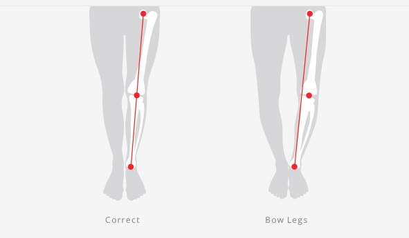 罗圈腿怎么治疗 怎么判断是不是罗圈腿