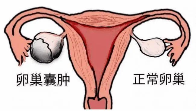 女人如何保养卵巢 妇科医生告诉你怎么保养卵巢