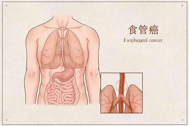 食道癌的放射治疗 食道癌放射治疗效果如何