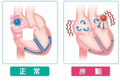 房颤手术有几种方式、房颤手术怎么做有风险吗