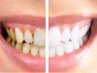 牙齿怎么美白比较好 牙齿美白价格详解