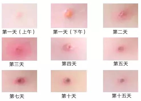 小孩起水痘能洗澡吗、小孩出水痘能吃鸡蛋吗