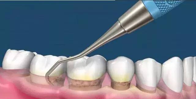 牙结石怎么去除小窍门、去除牙结石疼不疼