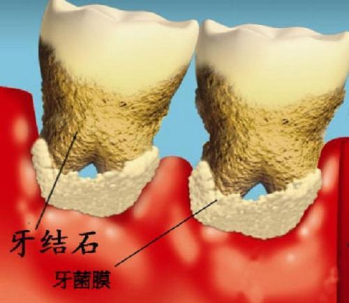 如何去除牙结石、牙膏能去除牙结石吗