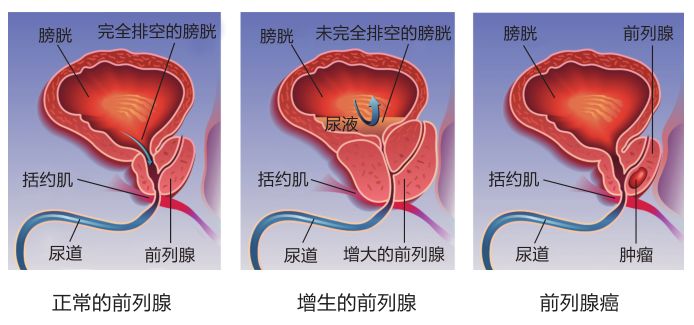 前列腺增生怎么手术、前列腺增生能够治疗好吗