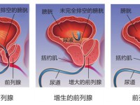 前列腺增生怎么手术、前列腺增生能够治疗好吗