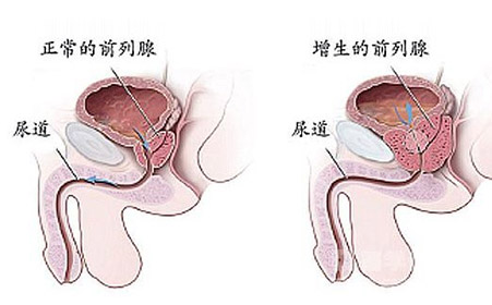前列腺快感和射精区别有哪些 防治前列腺炎的食物有哪些