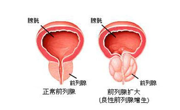 前列腺痛与情绪有关系吗、引发前列腺痛的原因是什么