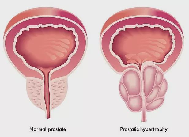 前列腺增大的治疗方法 前列腺有哪些症状表现