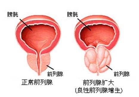 前列腺增生的手术治疗方法 前列腺增生是怎么了