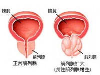 前列腺增生的手术治疗方法 前列腺增生是怎么了